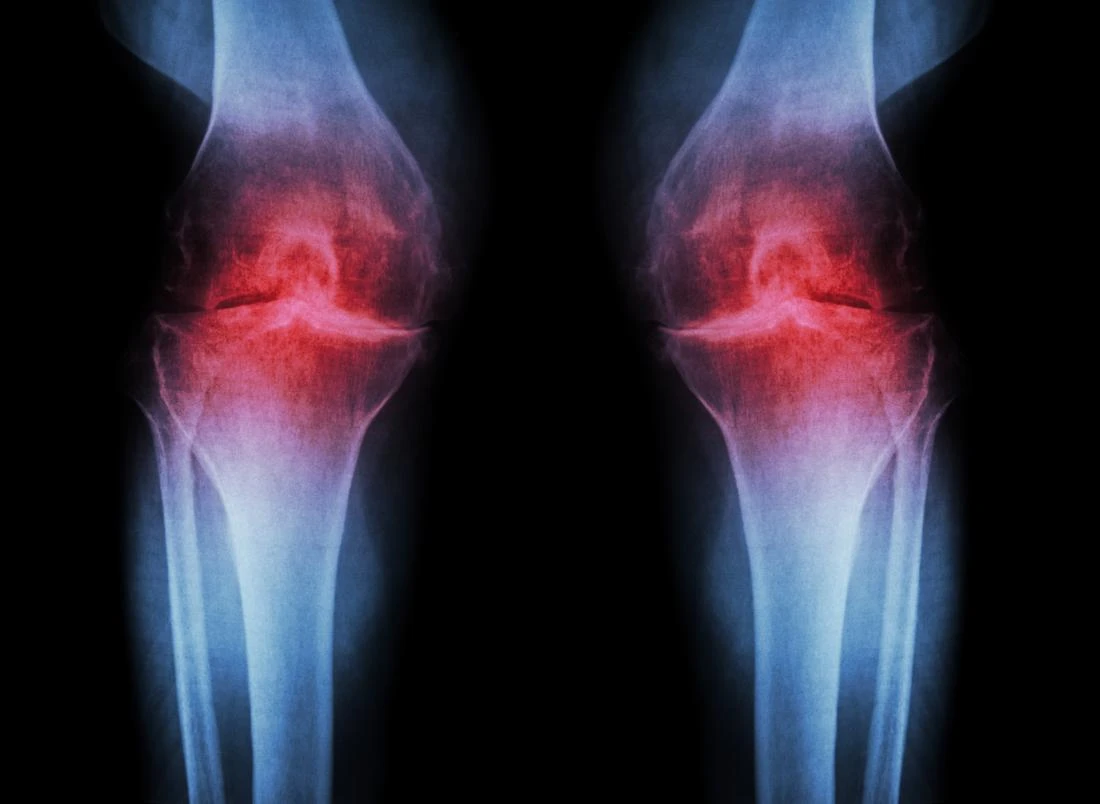 osteoartrit-of-the-knee